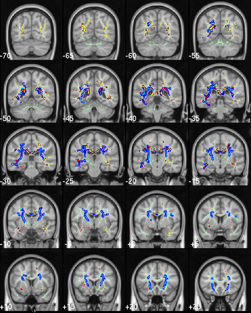 Explainer: Alzheimer's Disease | Descrier News
