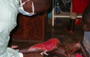 Buruli ulcer on leg and contractual deformity on wrist and hand.