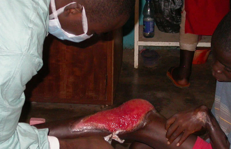 Buruli ulcer on leg and contractual deformity on wrist and hand.