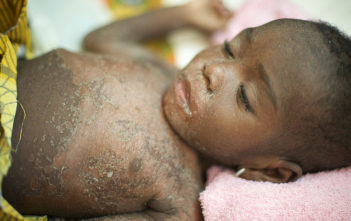 Child with measles