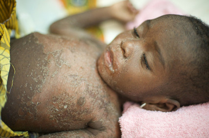 Child with measles