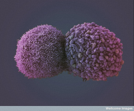 Lung cancer cells