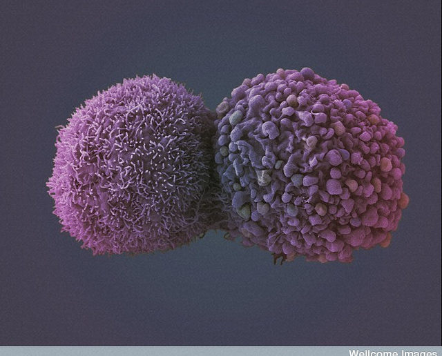 Lung cancer cells