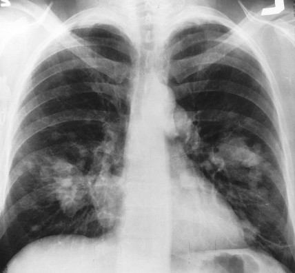 Chest cancer X-ray
