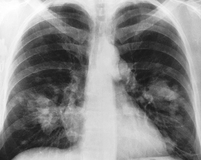 Chest cancer X-ray