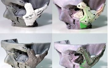 3D printed cheekbone and eye socket models and implants
