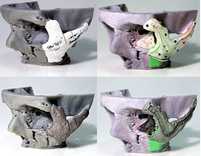 3D printed cheekbone and eye socket models and implants