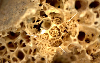 Image showing new bone formation in the iliac crest