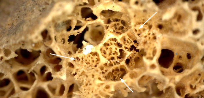 Image showing new bone formation in the iliac crest