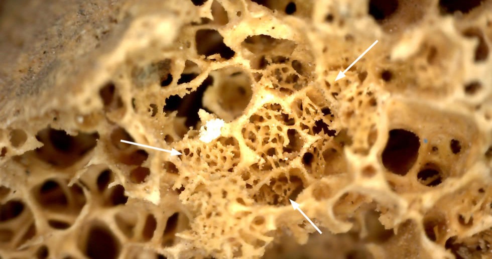 Image showing new bone formation in the iliac crest