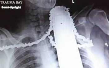 Treesurgeon suffers chainsaw neck injury