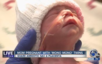 Mono Mono twins born holding hands