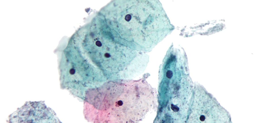 Micrograph showing Trichomoniasis