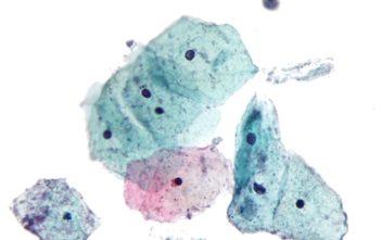 Micrograph showing Trichomoniasis