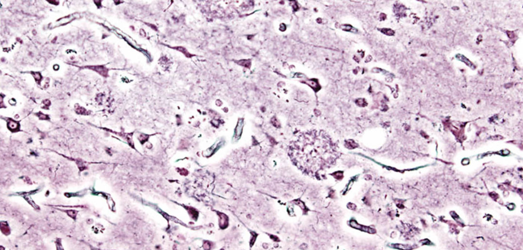 Alzheimer's disease