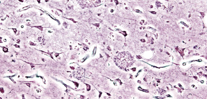 Alzheimer's disease